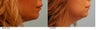 Lip Reduction