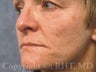 Permanent lip enlargement and Laser Treatment