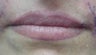 Lip Augmentation