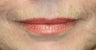 lip filler