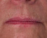 Lip Augmentation