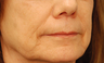 Injectable Filler