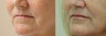 Fillers to the lips