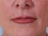 Lip Augmentation