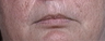 Lip Augmentation