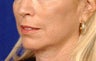 Beforeand After Lip Augmentation