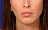 Before and After Lip Augmentation