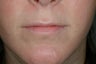 Lip enhancement