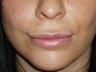 Lip Augmentations