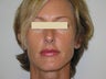 Advamta Lip Augmentation