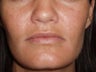 Lip Augmentations