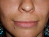 Lip Augmentations