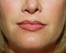 Lip lift, corner of lip lift, and filler in lips