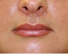 Modified lip lift