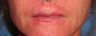 Lip Lift