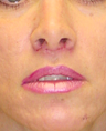 Lip Lift