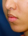 Lip Lift