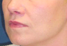 Lift Lip