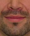 Lip Lift