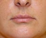 Modified lip lift