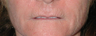 Lip Lift