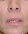 Lip Lift