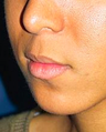 Lip Lift