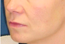 Lift Lip