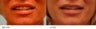 Lip reduction