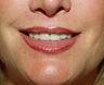 Lip lift, corner of lip lift, and filler in lips