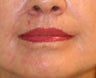 Lip lift, corner of lip lift, and laser treatment of wrinkles around lips