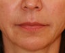 Anguloplasty