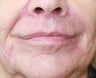 Lip lift, corner of lip lift, and filler around lips
