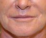 Lip lift, corner of lip lift