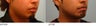 Upper and Lower Lip Reduction