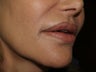 Under Lip Revision