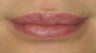 Lip Surgery, Lip Reduction