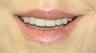 Lip Surgery, Lip Reduction