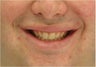 Lip Surgery, Lip Reduction