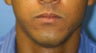 Lip Surgery, Lip Reduction