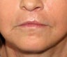 lip lift
