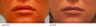 Lip reduction