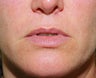 Lip lift, corner of lip lift, and filler in lips