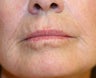 Lip lift, corner of lip lift, and laser treatment of wrinkles around lips