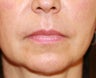 Anguloplasty
