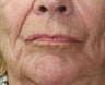Lip lift, corner of lip lift, and filler around lips