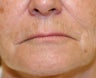 Lip lift, corner of lip lift