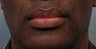 Cheiloplasty