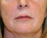 Lip Lift