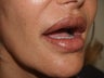 Under Lip Revision
